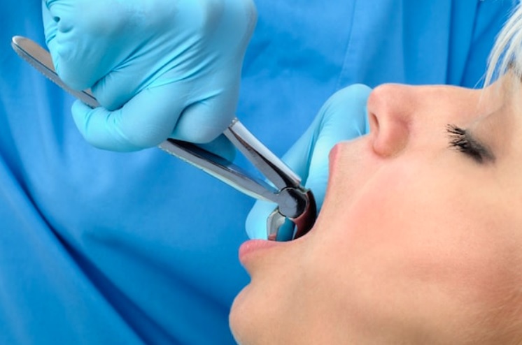 Tooth Extraction